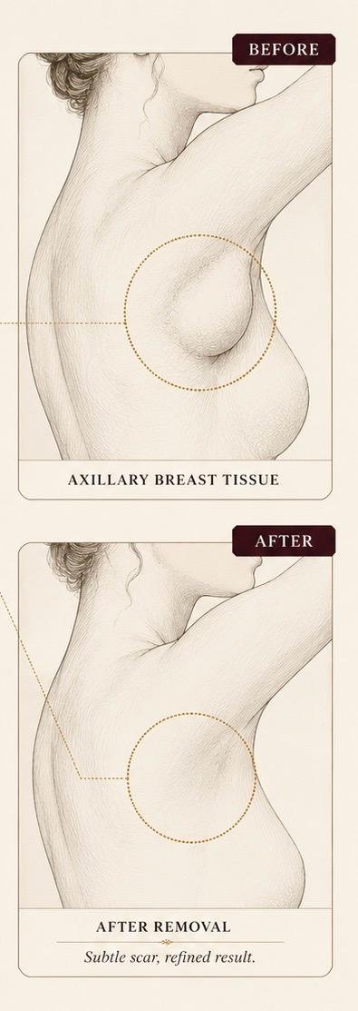 Illustration showing accessory breast tissue in the axillary underarm area