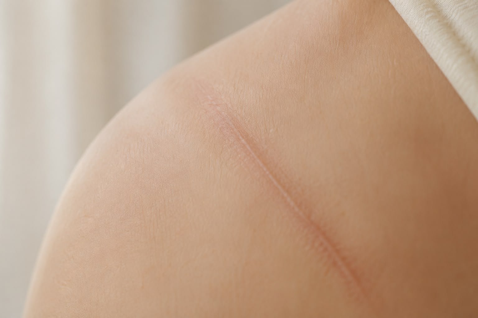 Close-up of a healed surgical scar